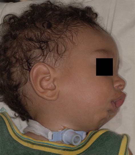 Tracheostomy-dependent child with temporomandibular ankylosis and ...