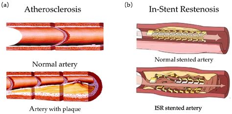 Micromachines | Free Full-Text | Structural Design of Vascular Stents ...