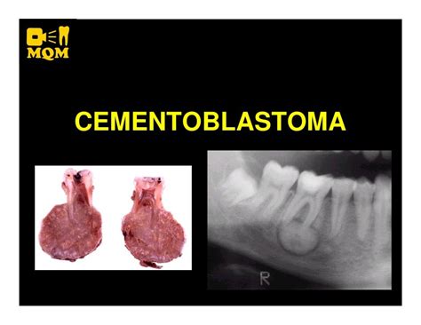 Cementoblastoma Histology