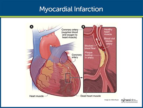 Myocardial Infarction: Nursing Care Management and Study Guide