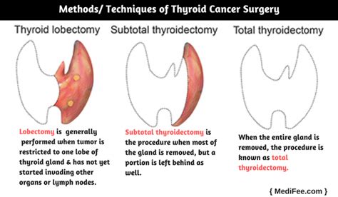 Thyroid Cancer Surgery: Procedure, Risks and Associated Complications