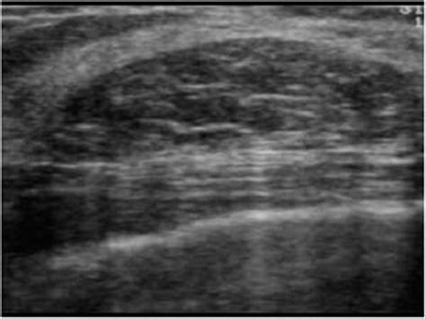 Breast and Axilla | 5.1 Benign lesions : Case 5.1.7 Lipomas ...