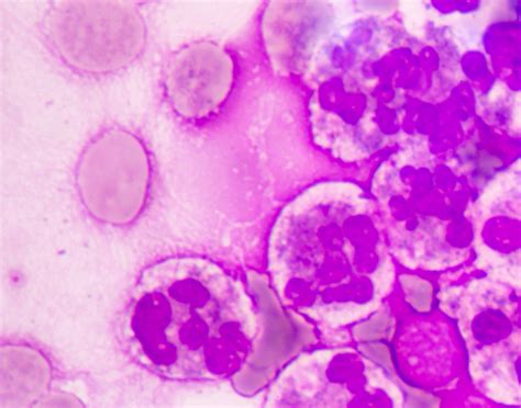 Cytology exam of pleural fluid