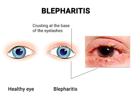 Eyelid Disease Blepharitis