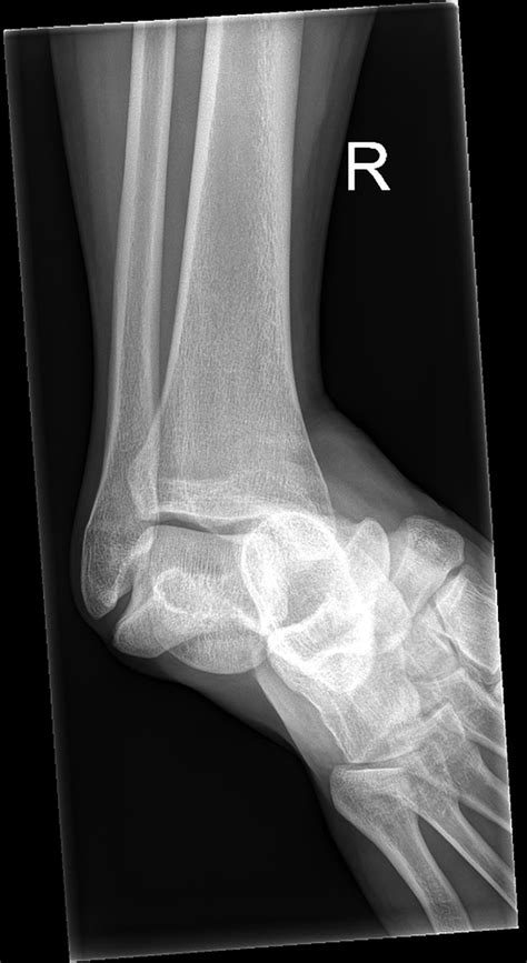 Subtalar dislocation secondary to a low energy injury | BMJ Case Reports