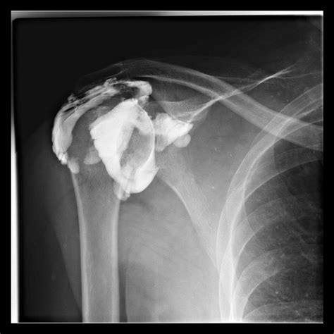 Rotator Cuff Tear Mri Arthrogram - cloudshareinfo