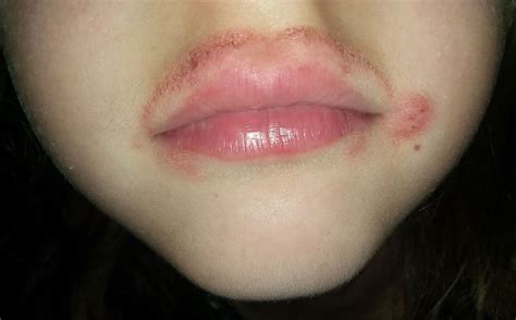 Allergic Reaction Bumps On Lips