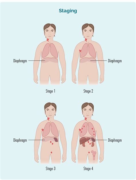 Staging of lymphoma - Lymphoma Australia