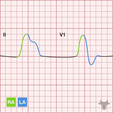 Left Atrial Enlargement | ECG Stampede