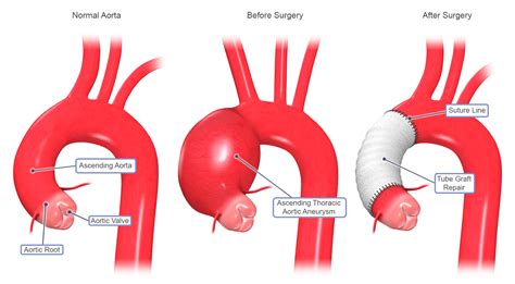 Aortic Aneurysm | MUHC Aortic Clinic - McGill University