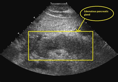 Acute pancreatitis ultrasound - wikidoc