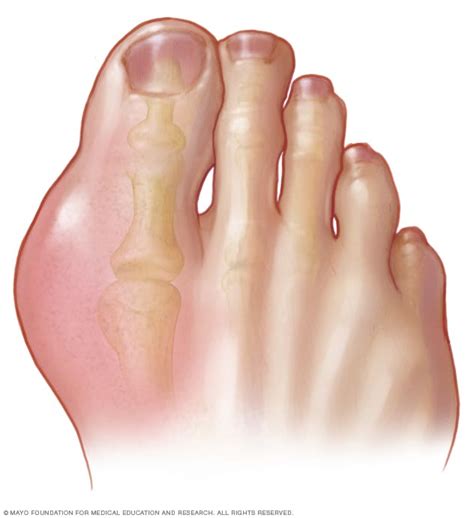 Gout - Symptoms and causes - Mayo Clinic