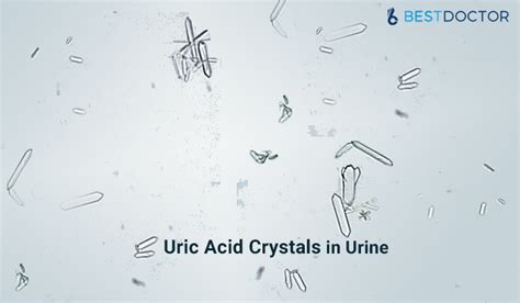 Uric Acid Crystals In Urine Infant