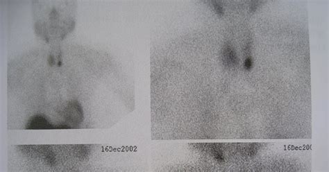 Nuclear Medicine - Another Way Of Learning: PARATHYROID SCAN