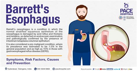 Barrett's Esophagus – Symptoms, Causes, Types And, 60% OFF