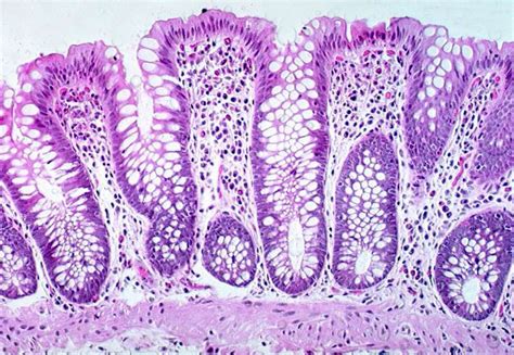 Non-neoplastic colorectal disease biopsies: evaluation and differential ...