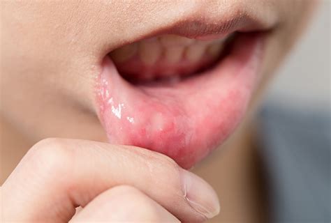 Home Remedies for Mouth Ulcers | Top 10 Home Remedies