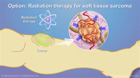 Diagnosing and Treating Soft Tissue Sarcoma