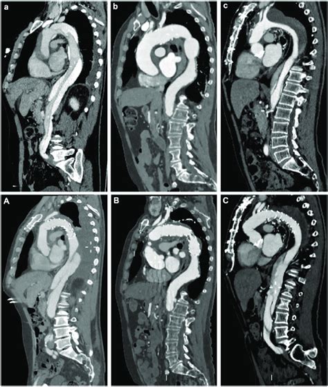 Indications for the frozen elephant trunk technique and preoperative ...