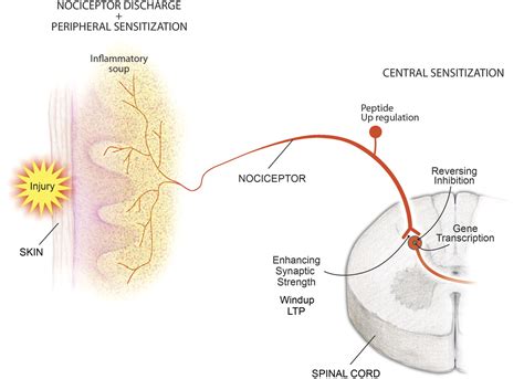 Acute vs Chronic Pain