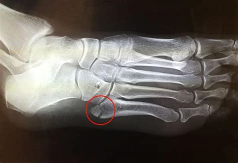 5th Metatarsal Stress Fracture Treatment & Management