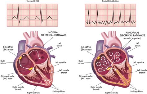 Atrial Fibrillation - About the Heart