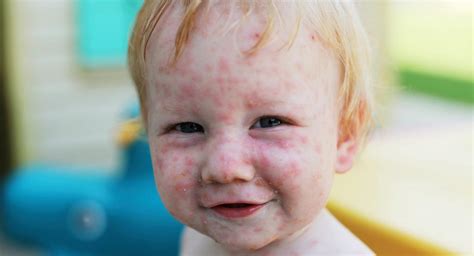 The chicken pox vaccine | BabyCenter