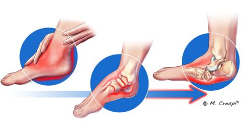 Charcot Arthropathy Symptoms and Initial Stage - Orthofix