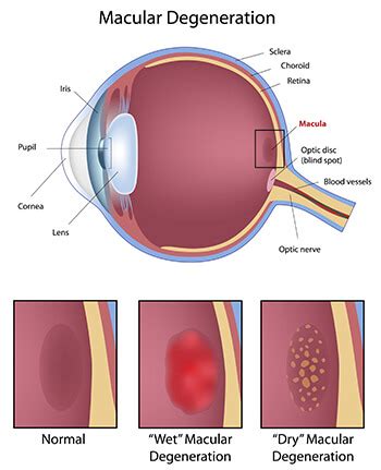 Macular Degeneration - Vitreo-Retinal Consultants