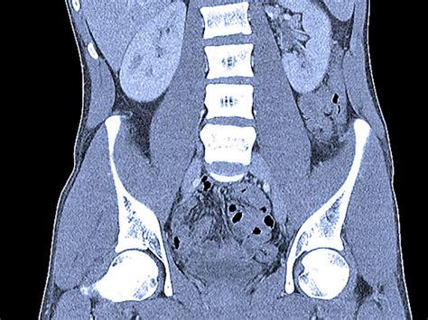 Abdominal CT scans: Definition, uses, picture, and more