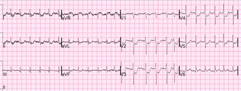 Dr. Smith's ECG Blog: Atrial Fibrillation w Rapid Ventricular Response ...