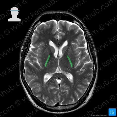 Normal brain MRI