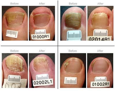 toenail fungal treatment before and after | Current Health Advice ...