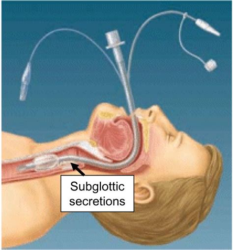 Endotracheal tube with subglottic suction port placed posteriorly and ...