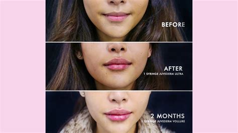 Which Better Restylane Vs Juvederm Lips - Healthy Anozo