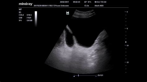 Ultrasound bladder diverticulum - YouTube