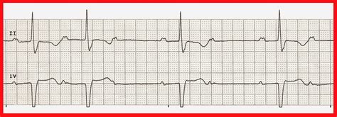 Various 2nd Degree Heart Block Type II