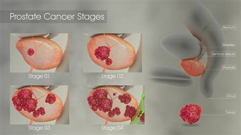 Prostate Cancer Stages - Scientific Animations