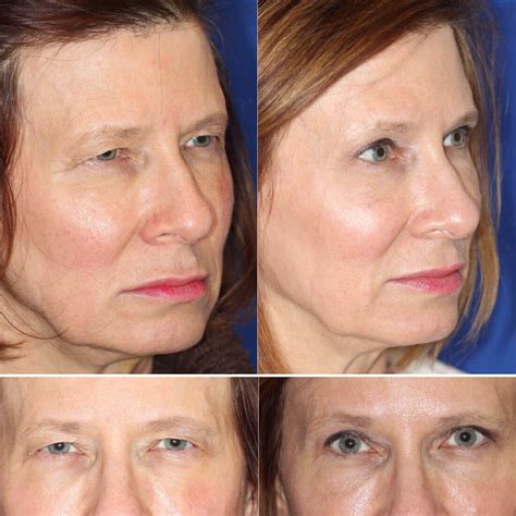 Upper Eyelid and Brow Lift Surgery - Dr. Dara Liotta