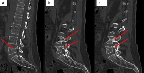 Cureus | Bilateral Acute Osteoporotic Lumbar Pedicle Fracture ...