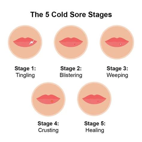 The 5 Cold Sore Stages: A Step-by-Step Guide – Luminance Red