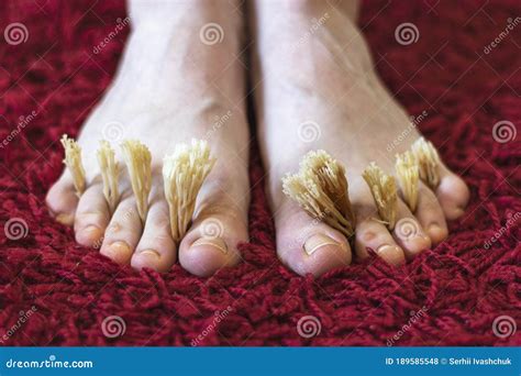 Coral Fungus between the Toes of Female Feet. Concept of Fungal Skin ...