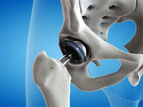 BEST HIP JOINT REPLACEMENT SURGERY IN KANPUR