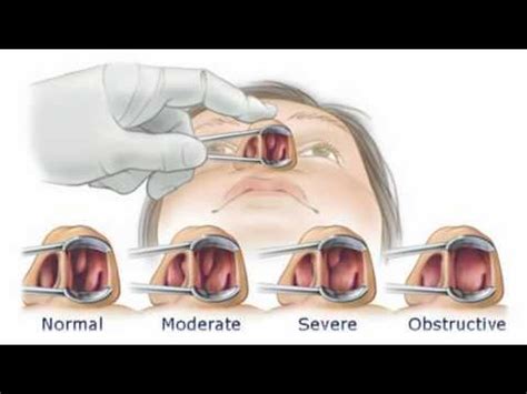 NASAL POLYPS HOME REMEDIES - YouTube