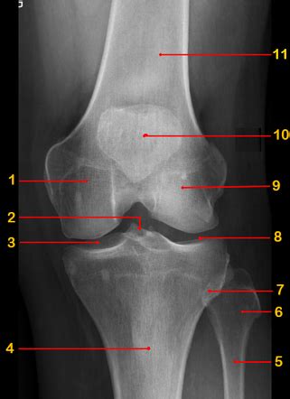 File:X-ray Of A Normal Knee By Anteroposterior Wikipedia, 45% OFF