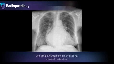 Left atrial enlargement on chest x-ray - radiology video tutorial - YouTube