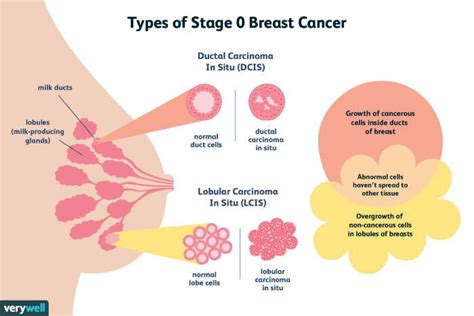 Breast Cancer: Types, Symptoms, Diagnosis, Treatment - PMCC Denver ...