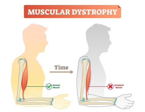 Muscular Dystrophy – Mitchell McConnell AEP – Vision Health