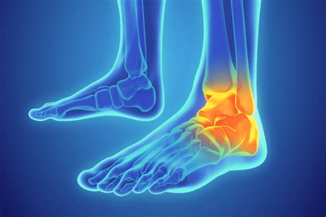 Ankle Sprains – Ankle Injuries – Symptoms and Treatments