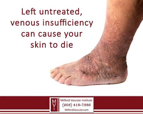 Venous Insufficiency Can Be Debilitating and Deadly If Untreated